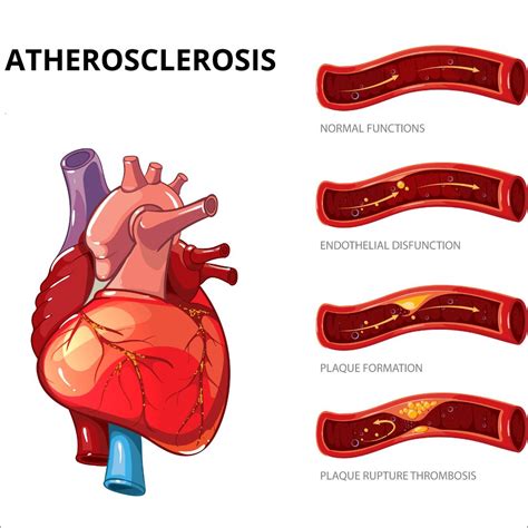 Arteriosclerosis .